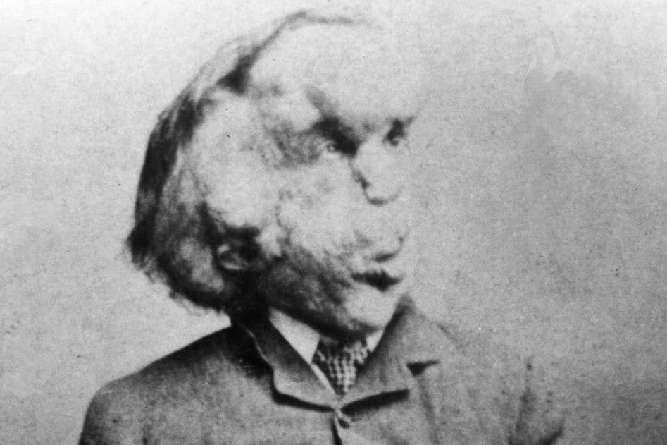 history of london elephant man